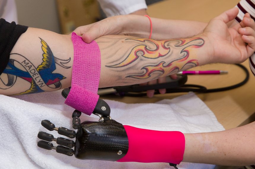 Prosthetic Technology Arm Dynamics